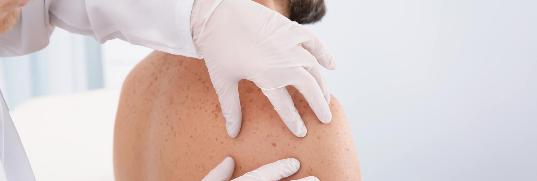 Benign Skin Lesions Plantation FL