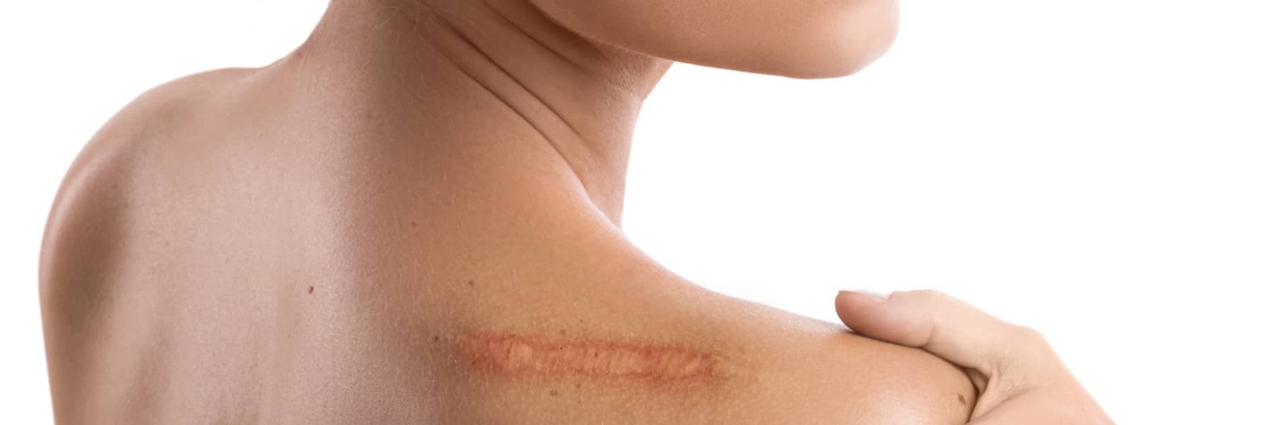 Hypertrophic Scars Plantation FL