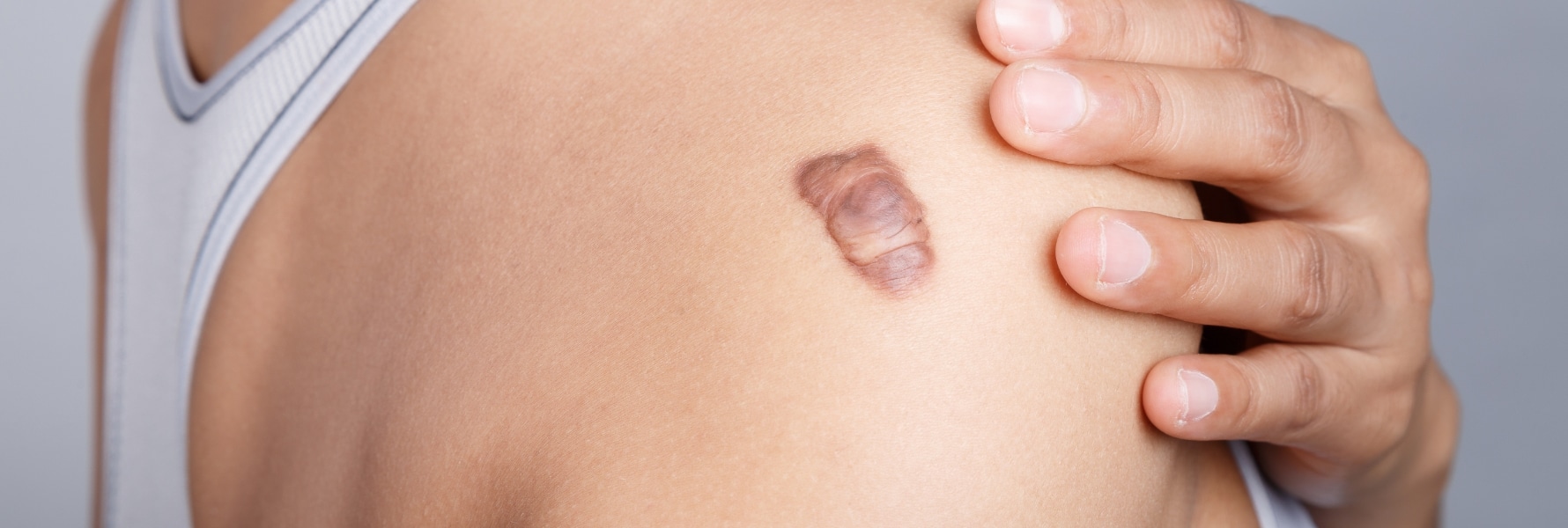 Keloids Treatment Plantation FL