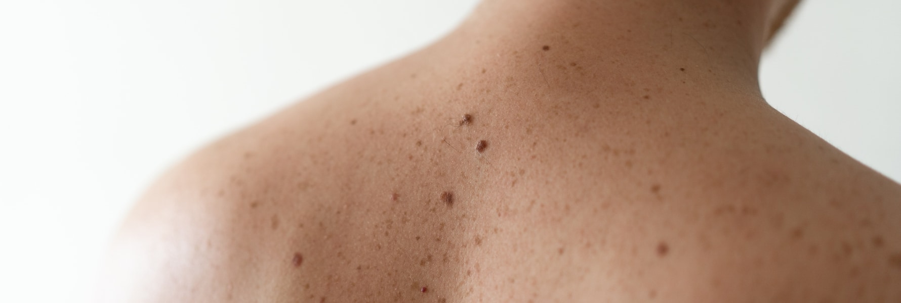 Moles And Birthmarks Plantation FL